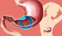 胃癌可以吃籽瓜吗,营养与健康的双重守护